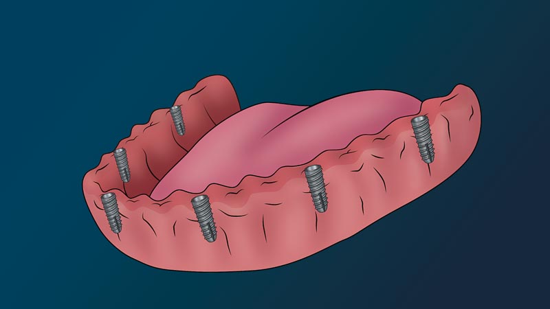 A full arch with no teeth. There are six dental implants in the gums.