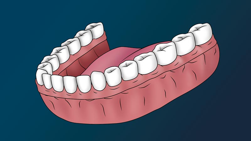 A full arch with all new and white teeth.