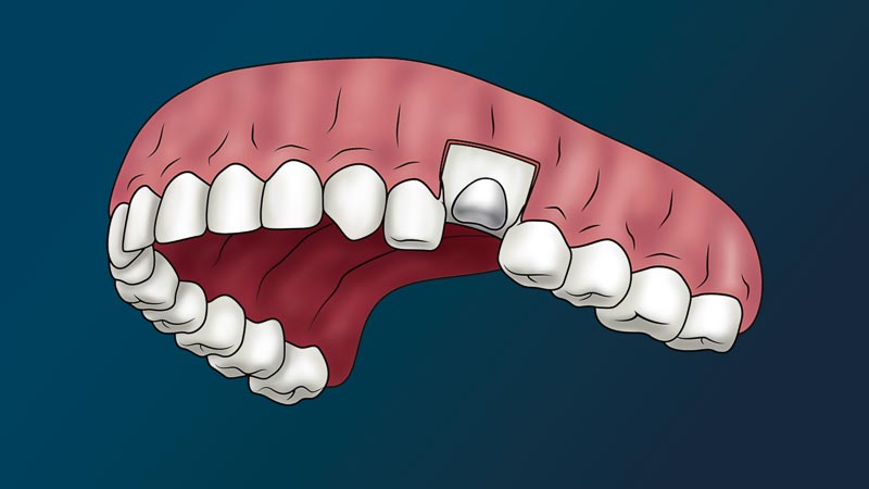 A full arch of teeth with one missing tooth. Bone from a bone graft has entered the hole.