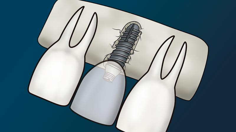 Three teeth and shown but the one in the middle has a dental implant. The tooth is lightly transparent to show the abutment the attaches to the crown.